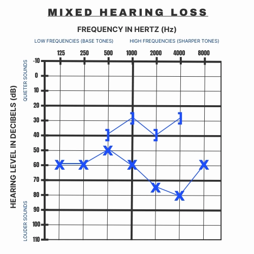 An example of what Mixed Hearing Loss looks like on an audiogram.